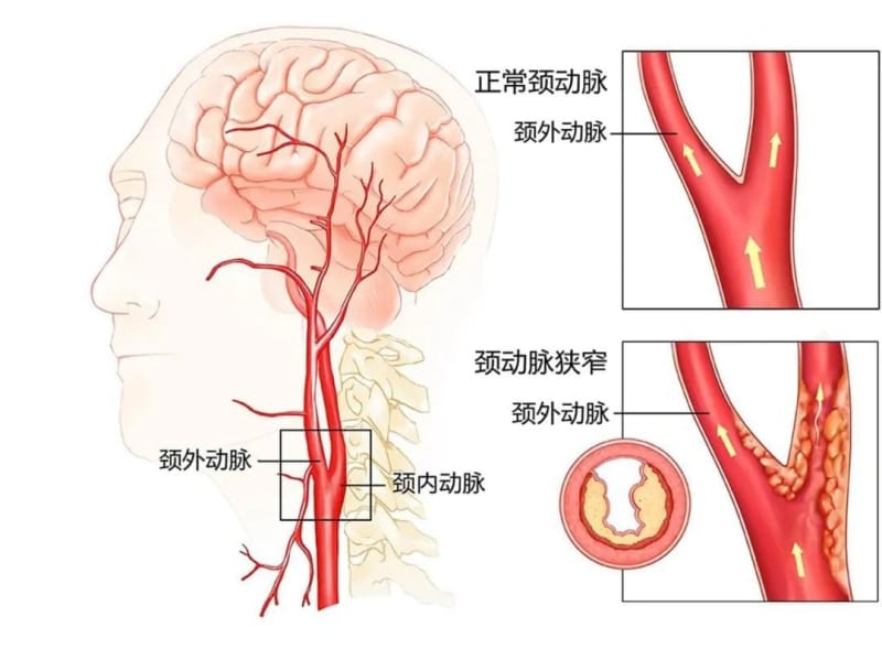 【州醫科普】劉龍生：重視頸動脈狹窄早期治療降低卒中的發生率