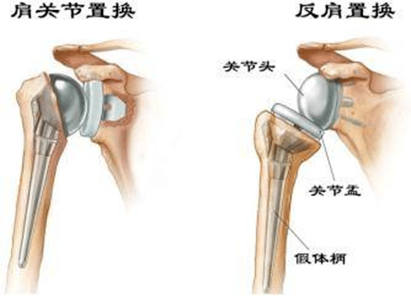 【新突破】黔西南州人民醫院關節外科成功實施多例“反式肩關節置換”手術