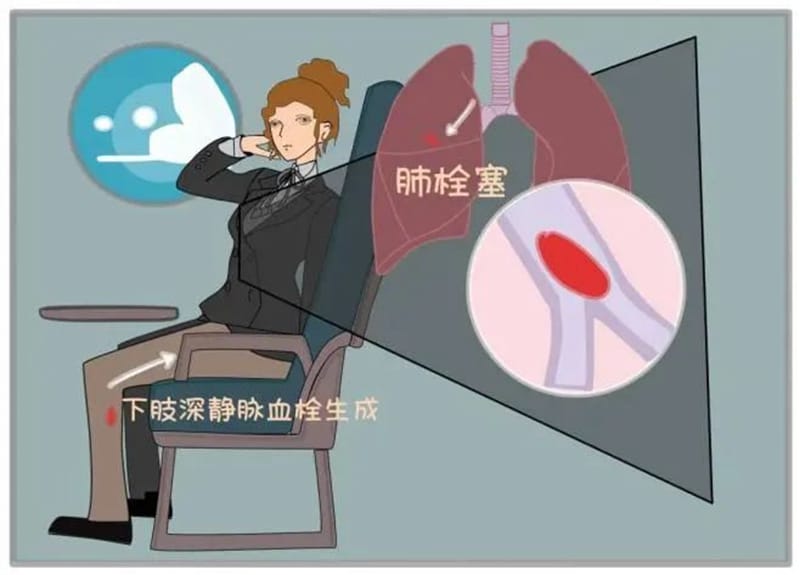 【州醫科普】關友兵：關愛血管 了解靜脈血栓的危害
