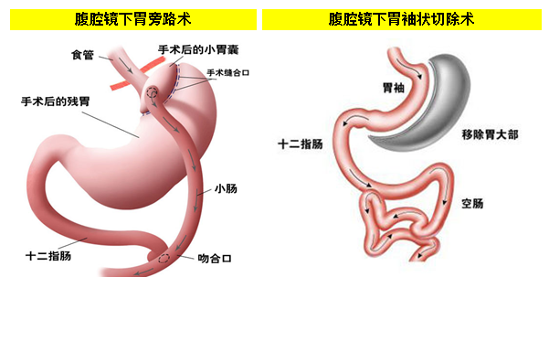 【國家喊你來減肥啦！】胃腸腹壁疝外科專家出手帶你告別肥胖人生